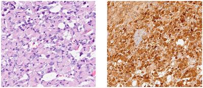 Frequency of IDH1 mutation in adult-type diffuse astrocytic gliomas in a tertiary hospital in Kenya